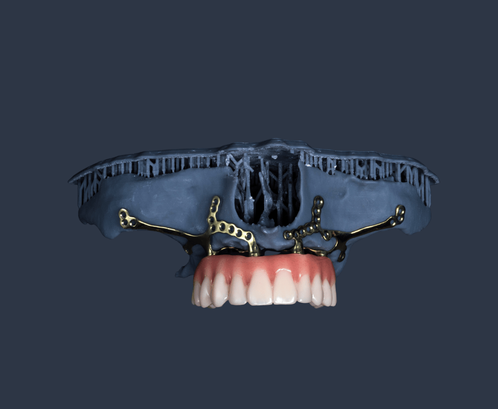 Subperio implants